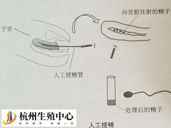 2025年做一次人工授精要花多少钱？一万元够不够呢？